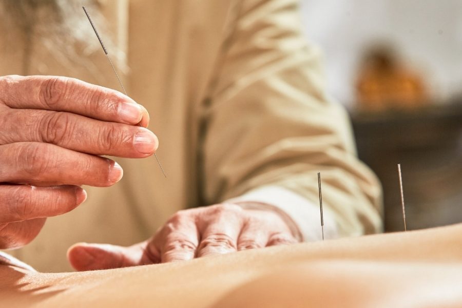 what to expect from acupuncture 